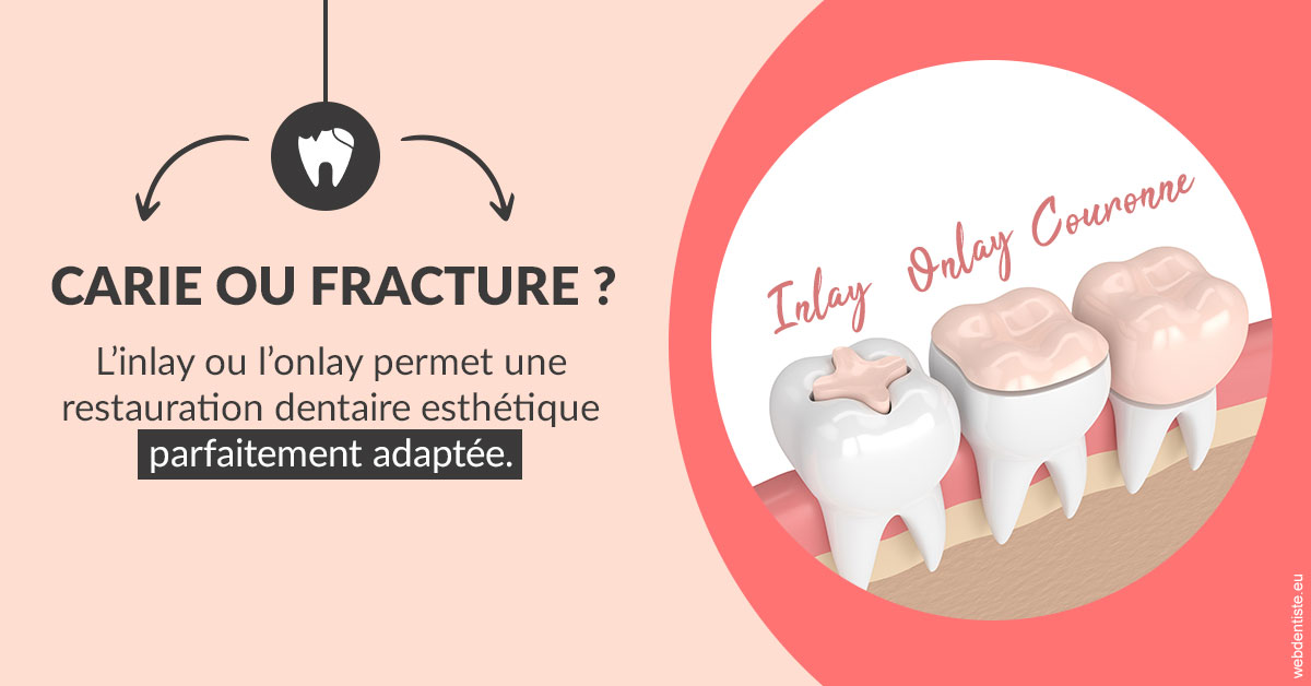 https://dr-guigue-eric.chirurgiens-dentistes.fr/T2 2023 - Carie ou fracture 2