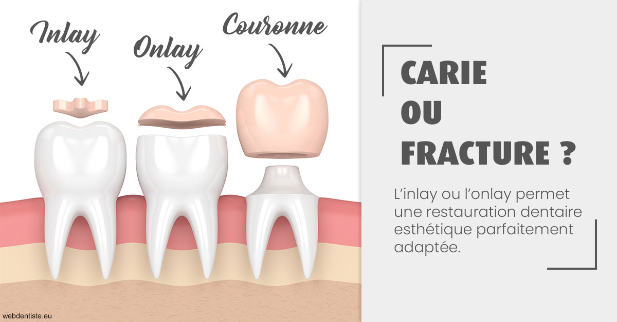 https://dr-guigue-eric.chirurgiens-dentistes.fr/T2 2023 - Carie ou fracture 1