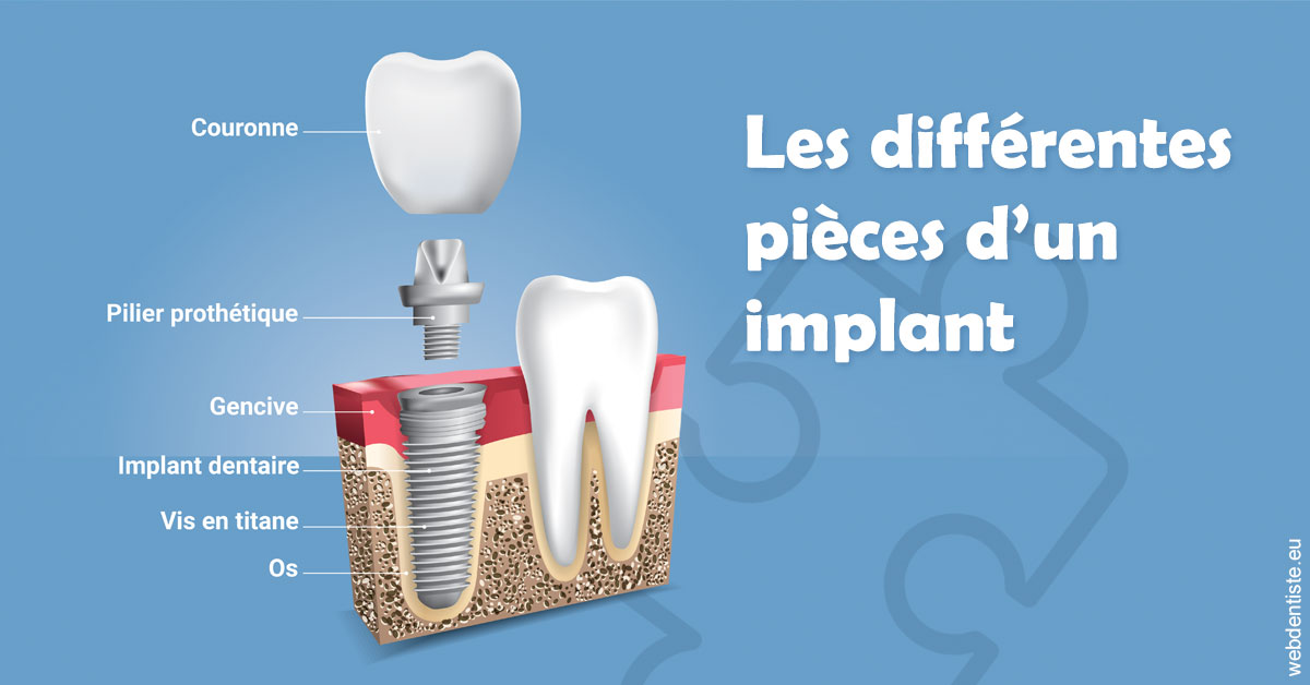 https://dr-guigue-eric.chirurgiens-dentistes.fr/Les différentes pièces d’un implant 1