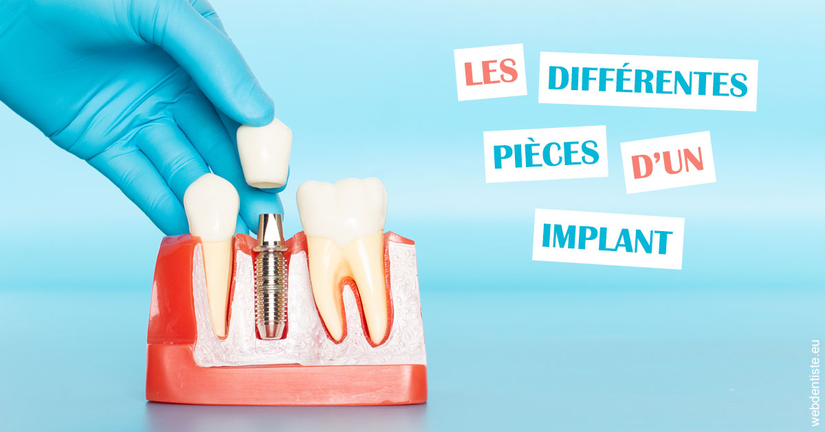 https://dr-guigue-eric.chirurgiens-dentistes.fr/Les différentes pièces d’un implant 2